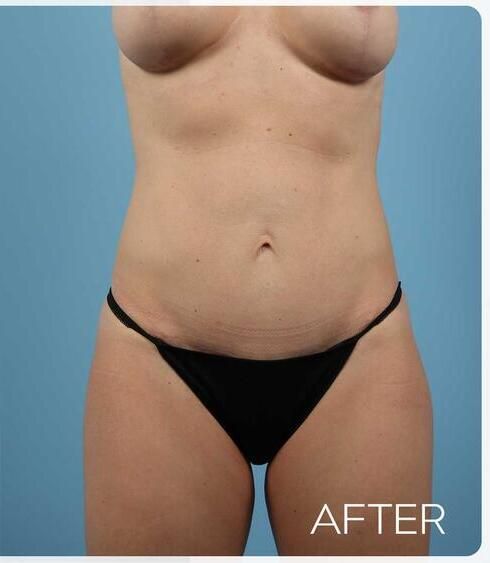 Abdominoplasty Before & After