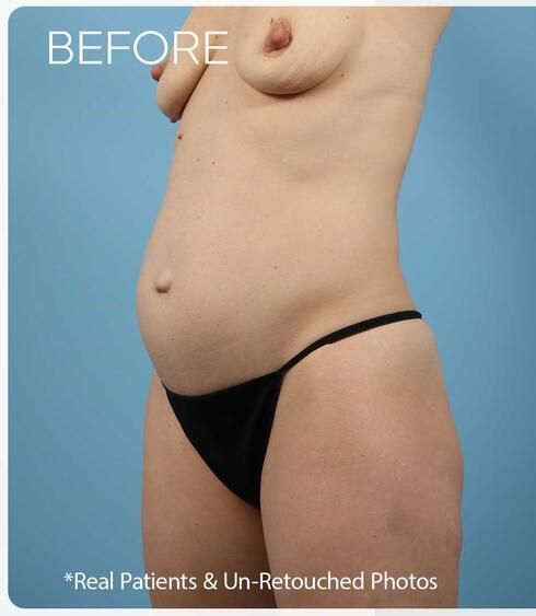 Abdominoplasty Before & After