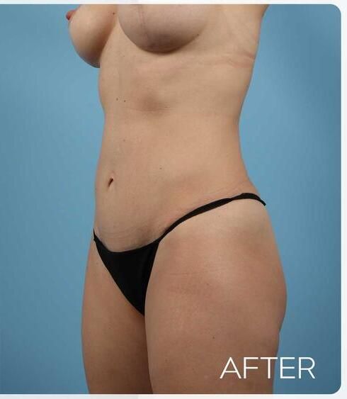 Abdominoplasty Before & After