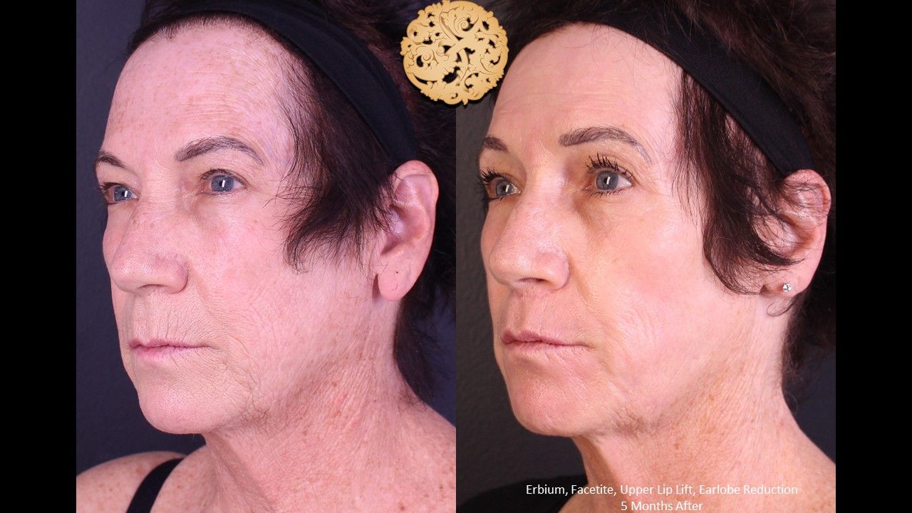 Facetite Before & After