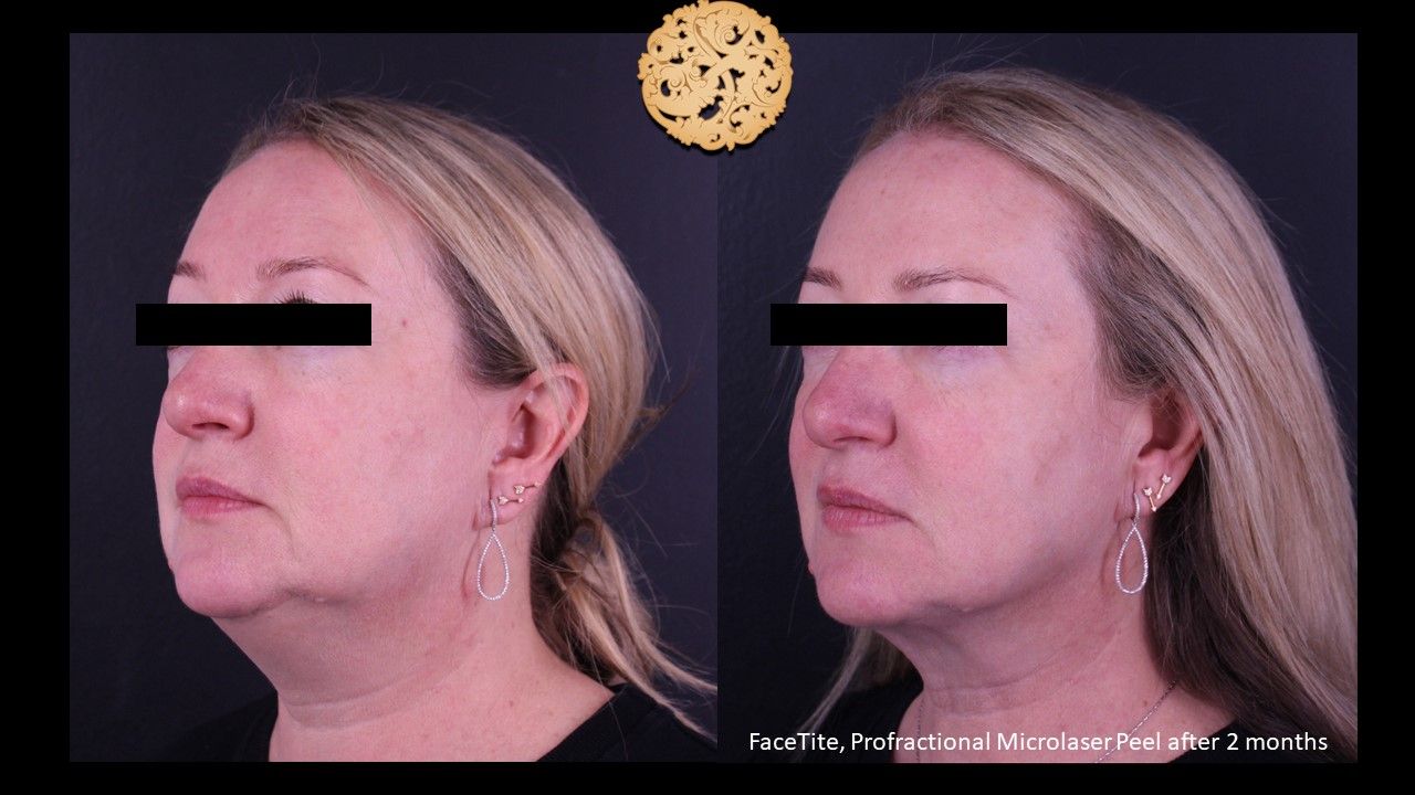 Facetite Before & After