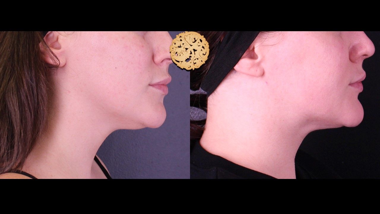 Facetite Before & After