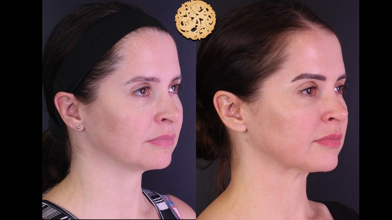 Facetite Before & After