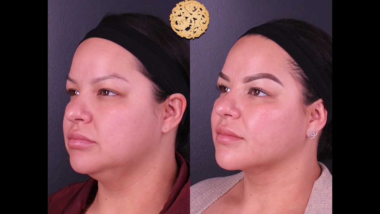 Facetite Before & After