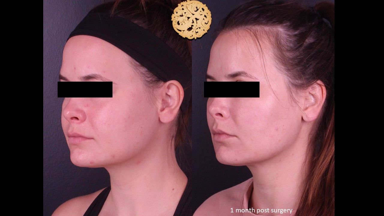 Facetite Before & After