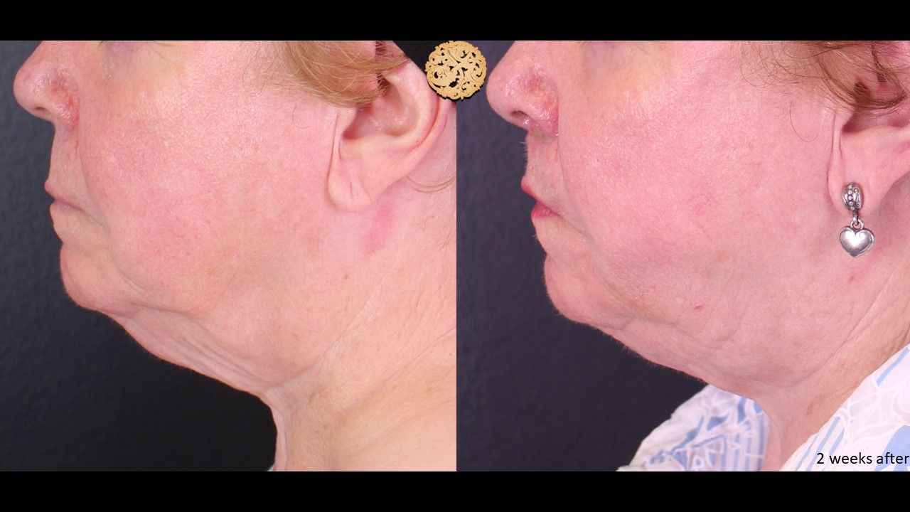 Facetite Before & After