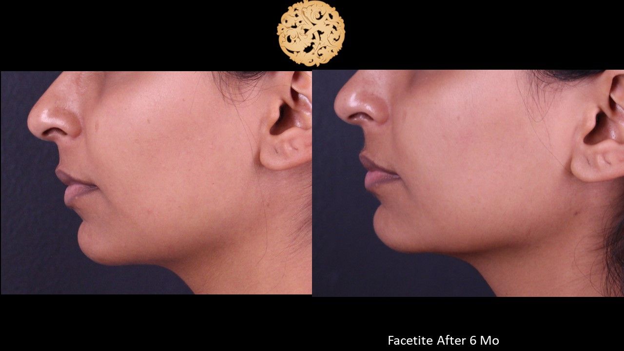 Facetite Before & After