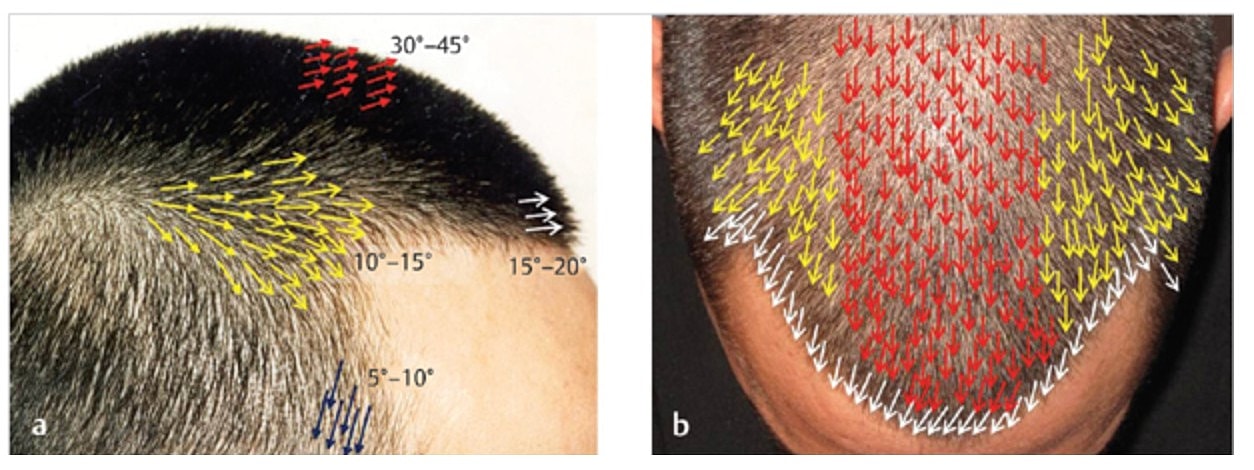 Hair density and angle illustration for transplantation.