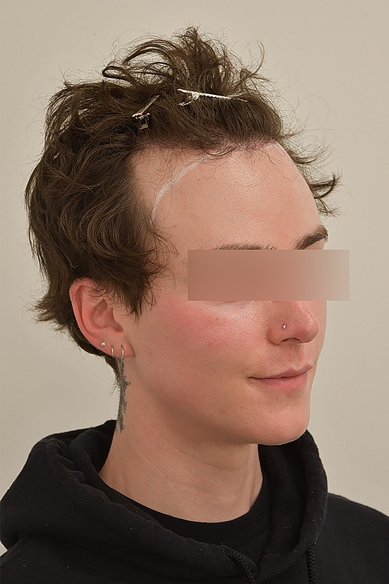 Gender-Affirming Hair Transplant (MTF) Before & After