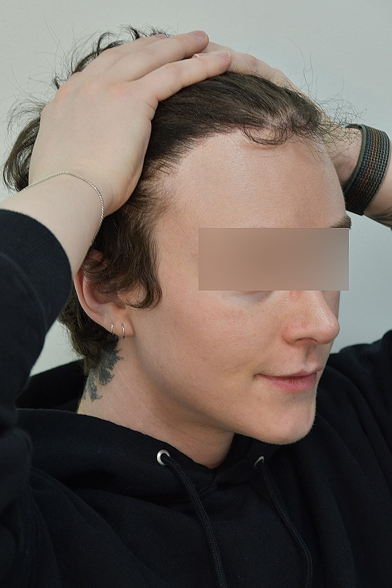 Gender-Affirming Hair Transplant (MTF) Before & After