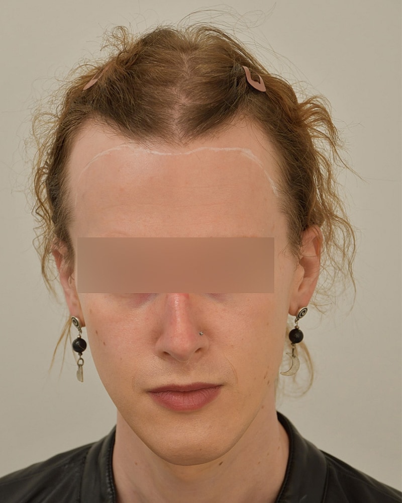 Gender-Affirming Hair Transplant (MTF) Before & After