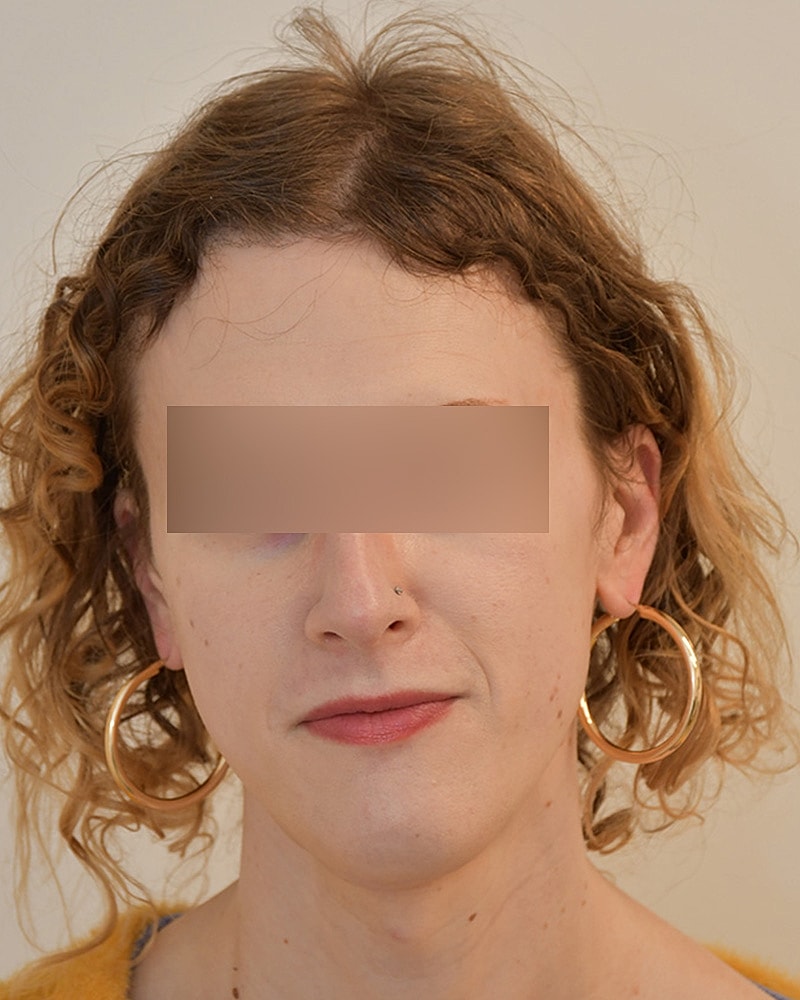 Gender-Affirming Hair Transplant (MTF) Before & After