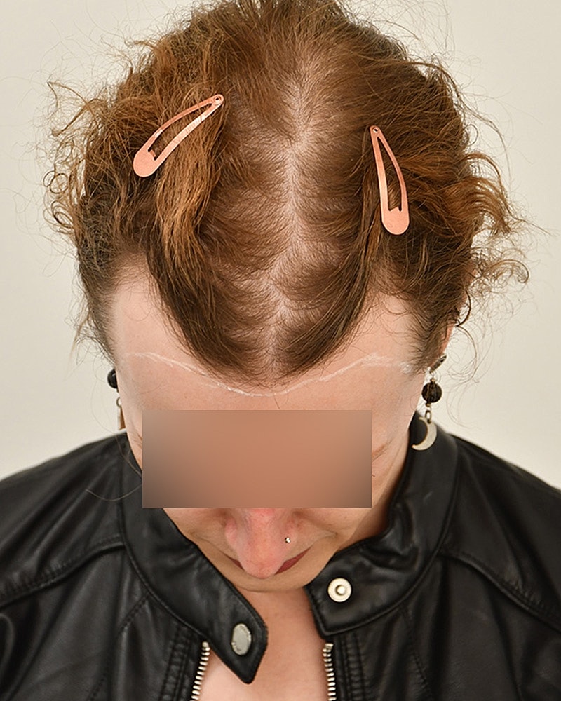 Gender-Affirming Hair Transplant (MTF) Before & After