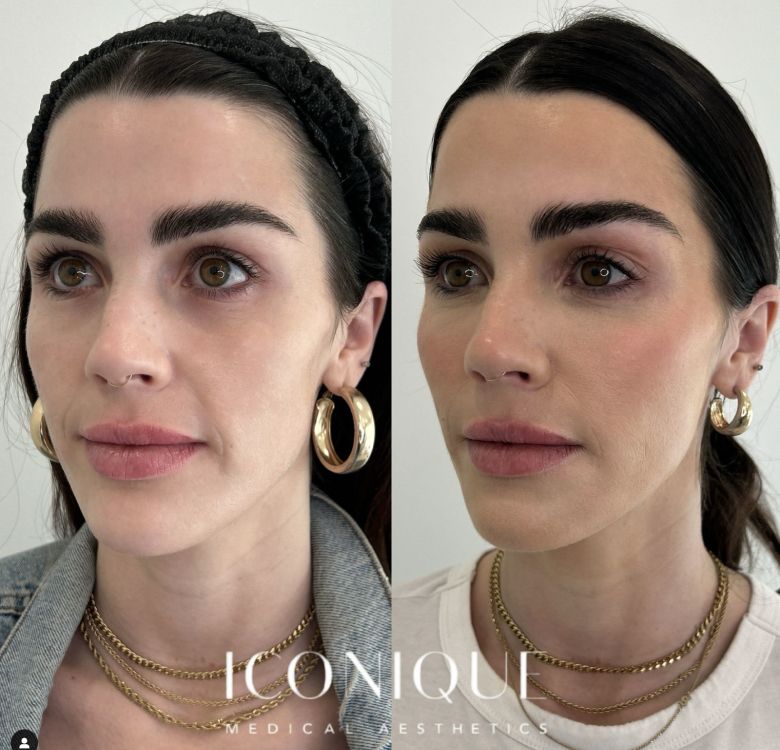 Before and after skincare treatment comparison.