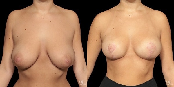 Breast Reduction Before & After