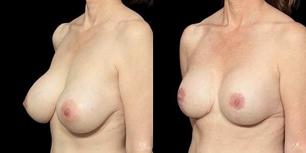 Implant Removal Replacement Before & After