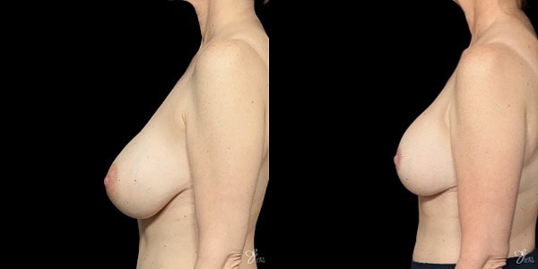 Implant Removal Replacement Before & After