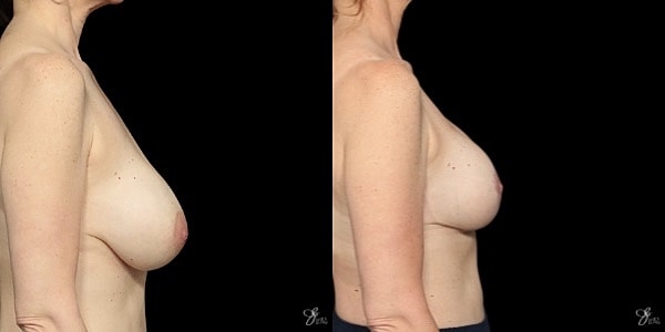 Implant Removal Replacement Before & After