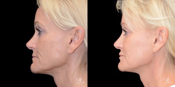 Facial Filler Before & After