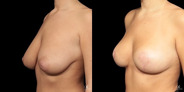 Adolescent Breast Correction Before & After