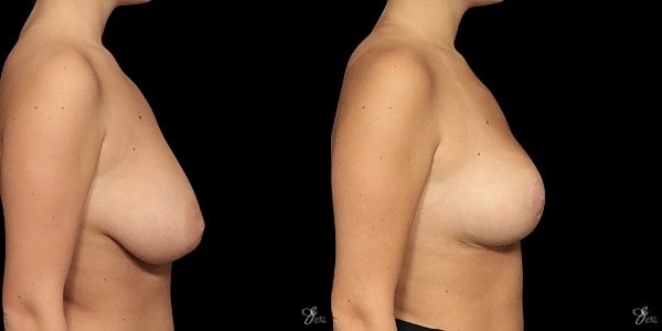 Adolescent Breast Correction Before & After