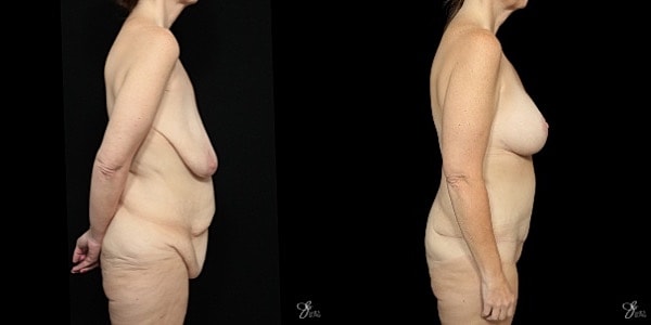 Mommy Makeover Before & After