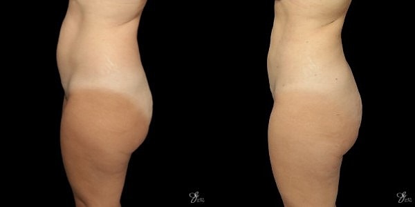 Liposuction Before & After