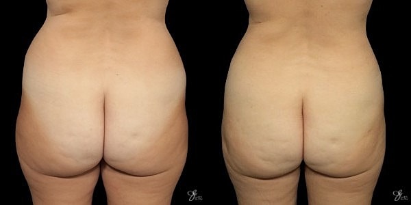 Liposuction Before & After