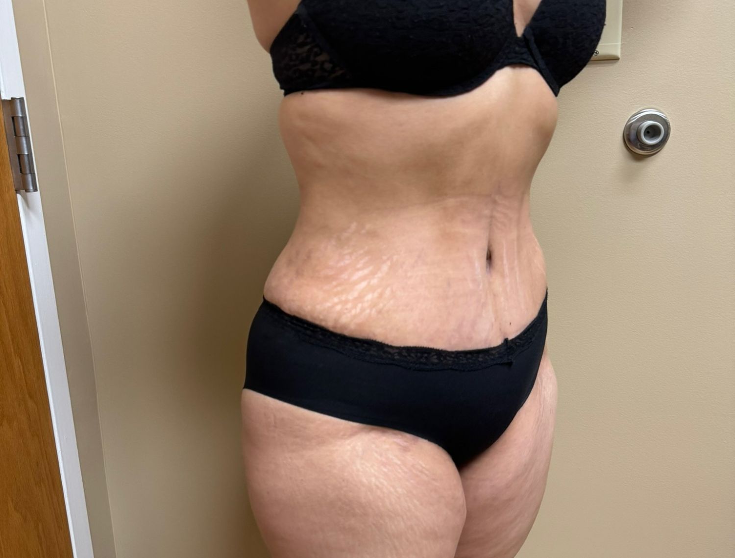 Tummy Tuck Before & After