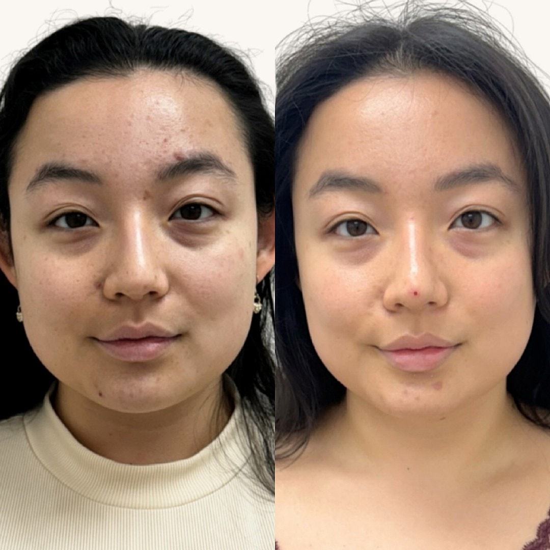 Before & After