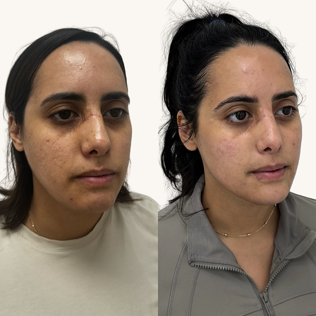  Before & After