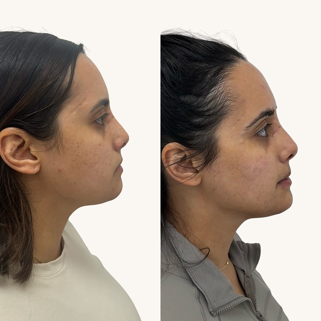  Before & After