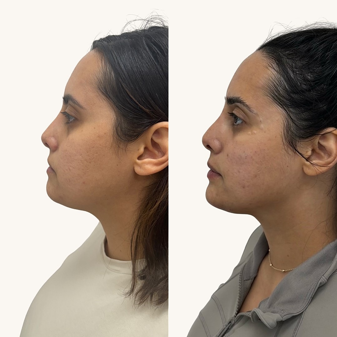  Before & After