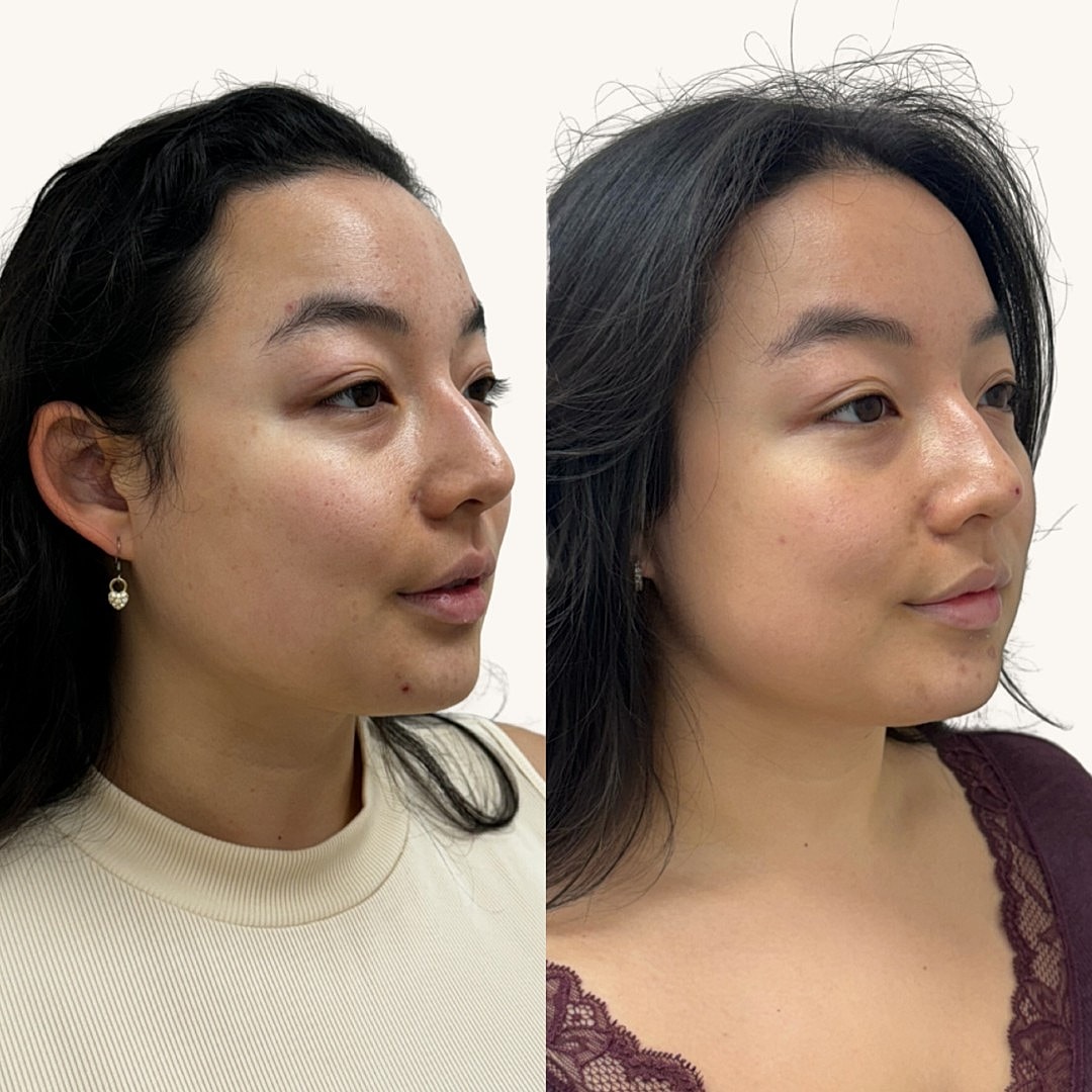  Before & After