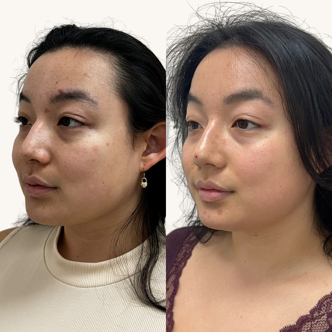  Before & After