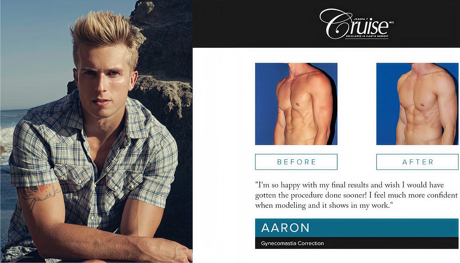 Man's gynecomastia correction before and after photos.