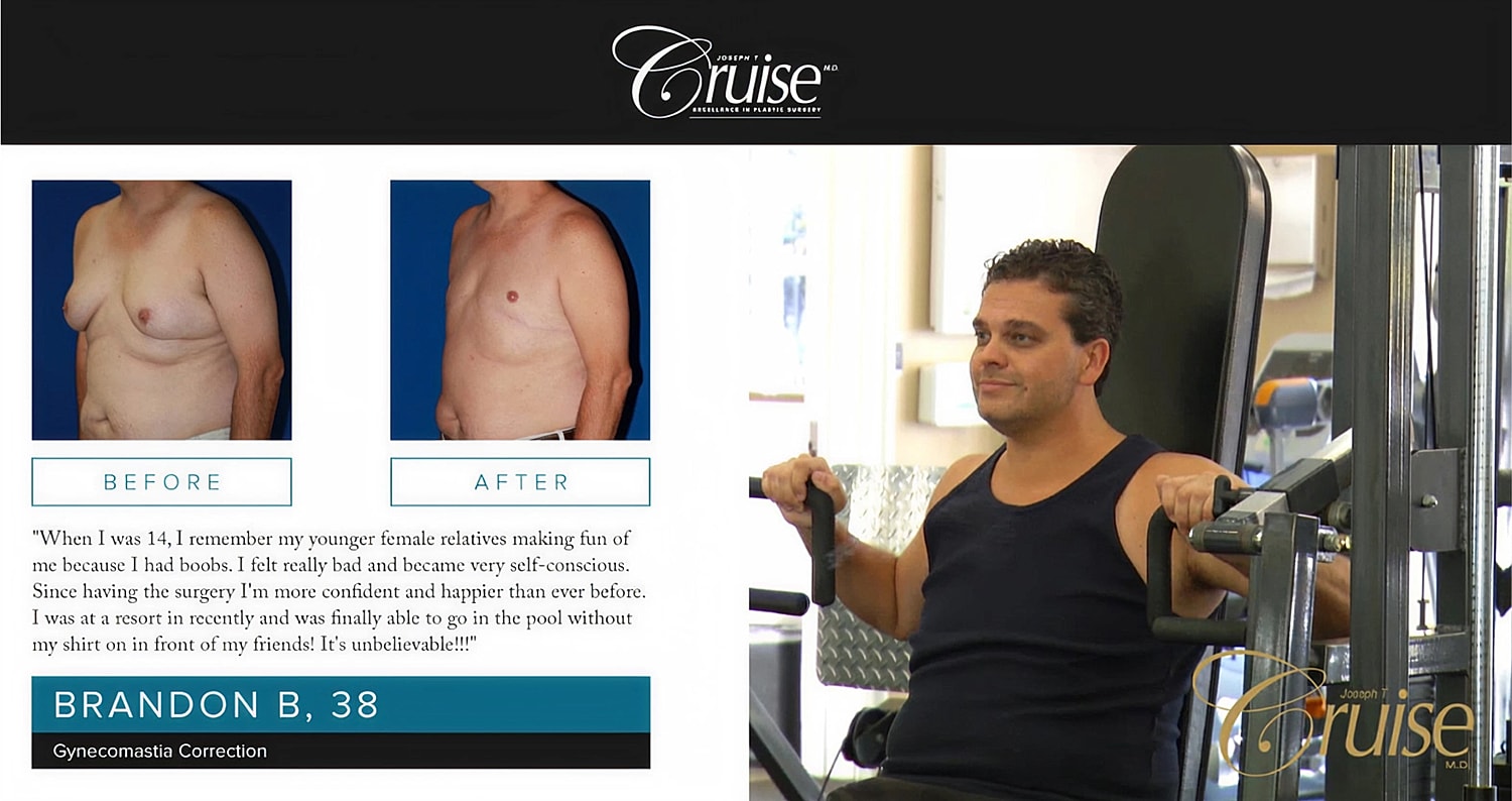 Man's gynecomastia correction before and after photos.