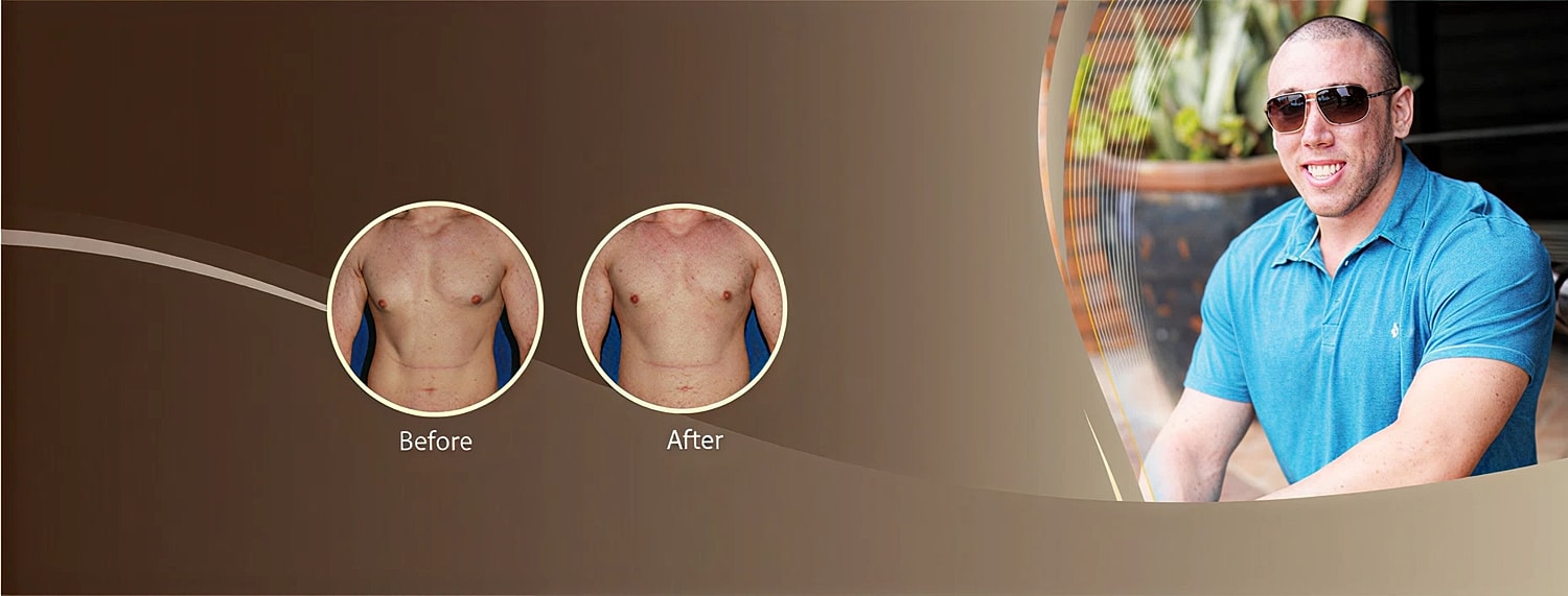 Male chest transformation before and after surgery.