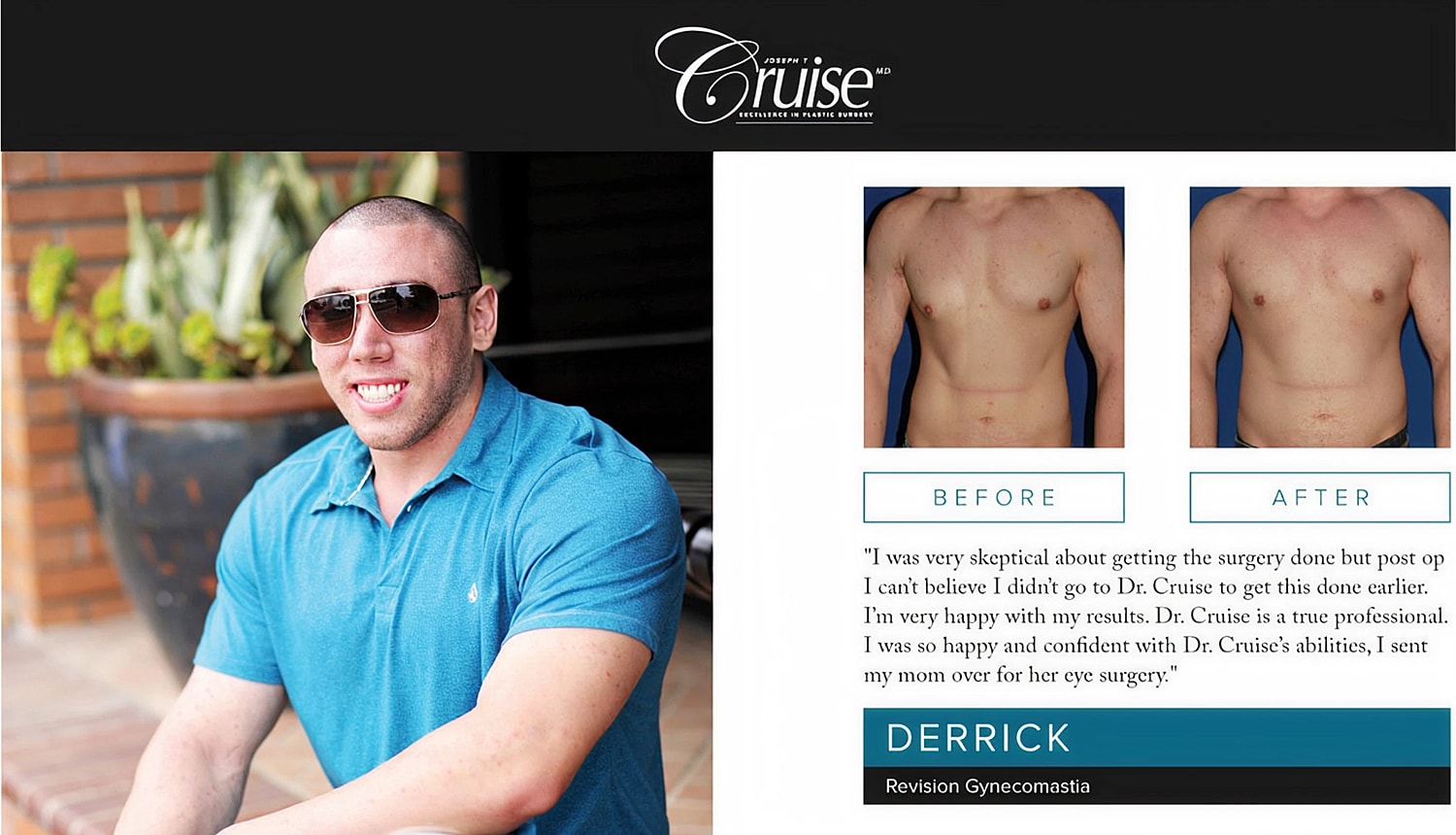 Man's gynecomastia correction before and after photos.