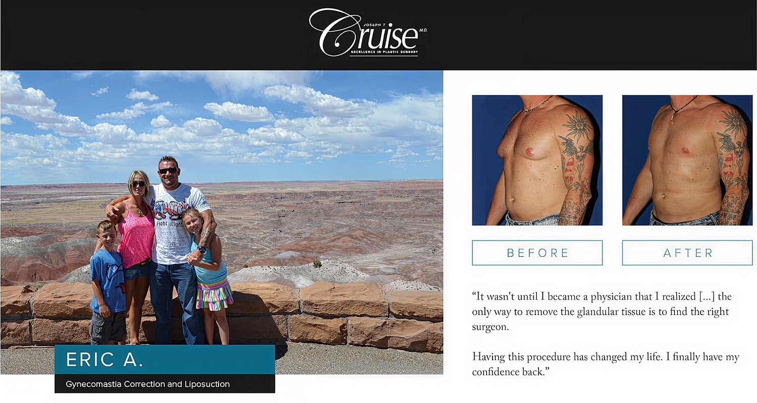 Man's gynecomastia correction before and after photos.