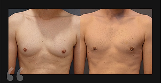 Before and after chest comparison image.