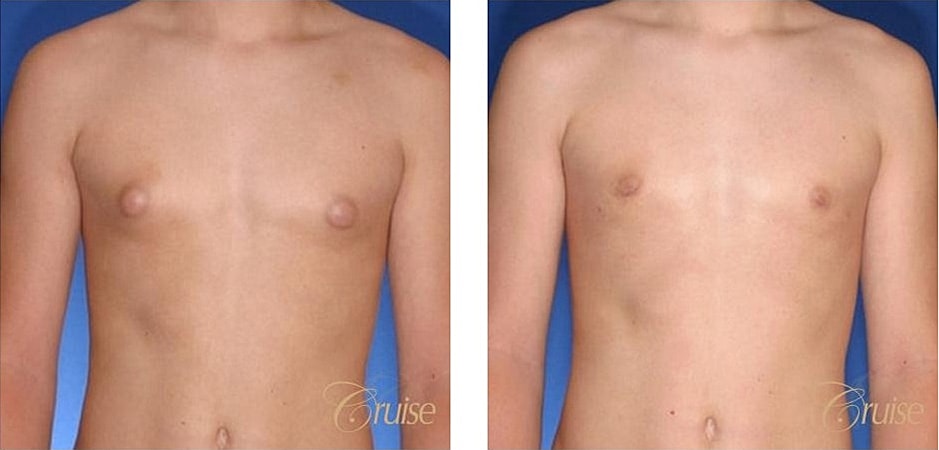 Type 1 Gynecomastia Before & After