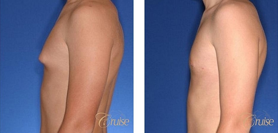 Type 1 Gynecomastia Before & After