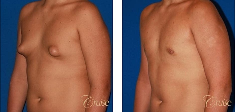 Type 1 Gynecomastia Before & After