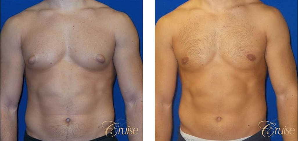 Bodybuilder Gynecomastia Before & After