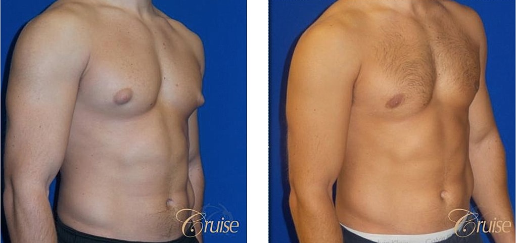 Bodybuilder Gynecomastia Before & After