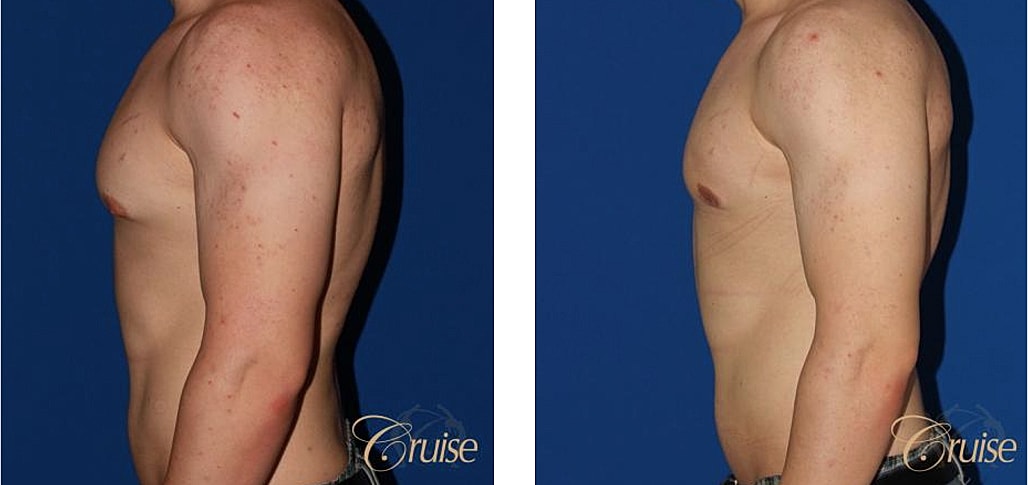 Bodybuilder Gynecomastia Before & After