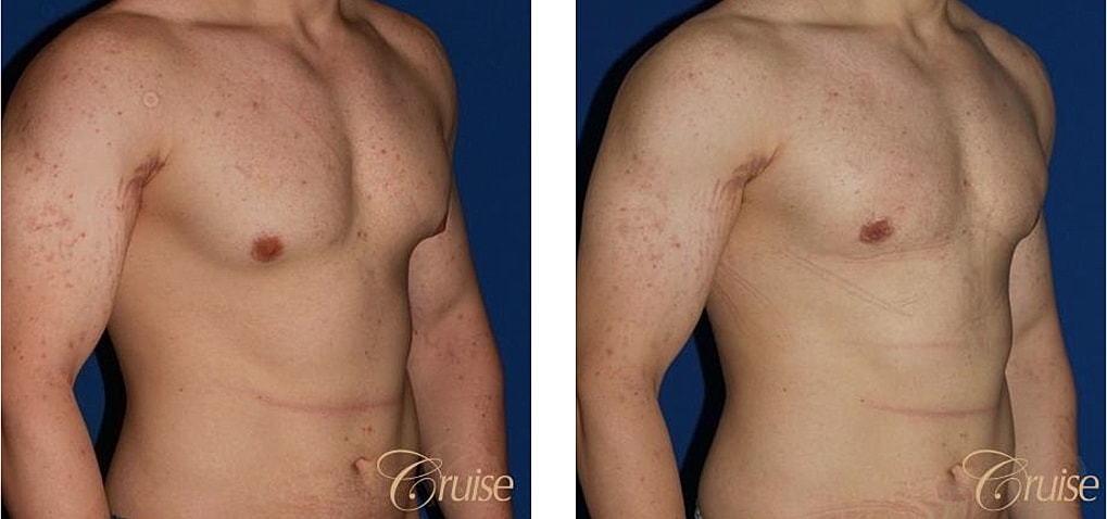 Bodybuilder Gynecomastia Before & After