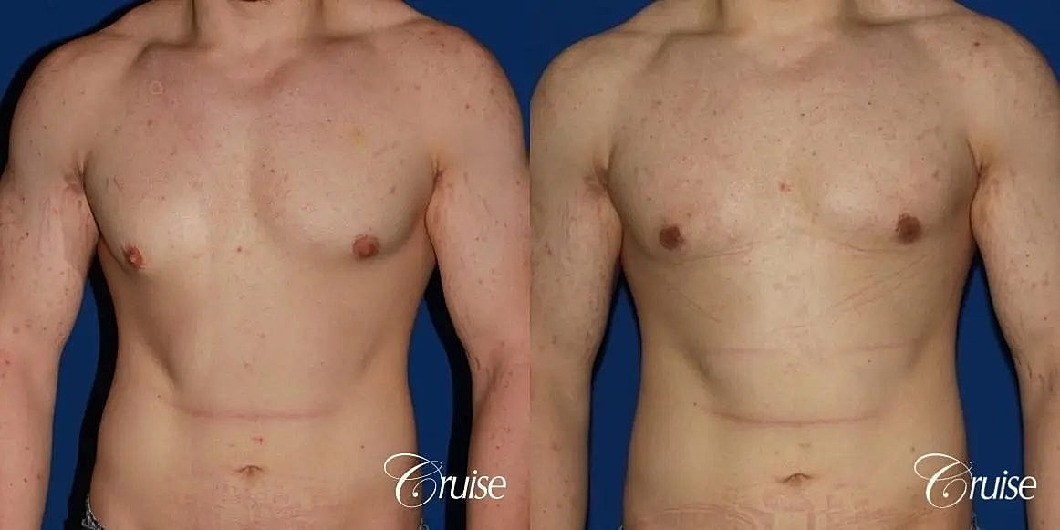 Gynecomastia Before & After