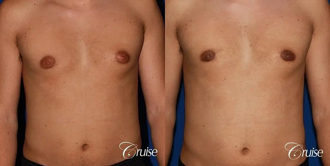 Gynecomastia Before & After